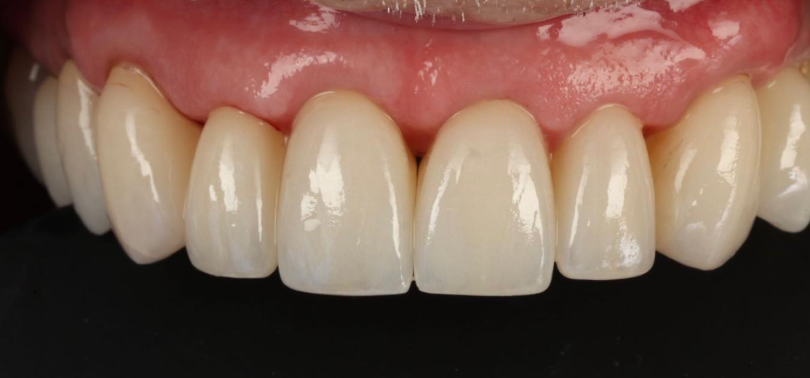 Case study after treatment