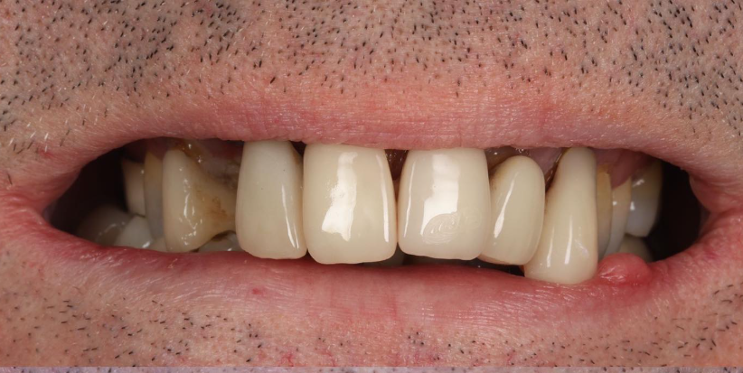 Case 4 before treatment